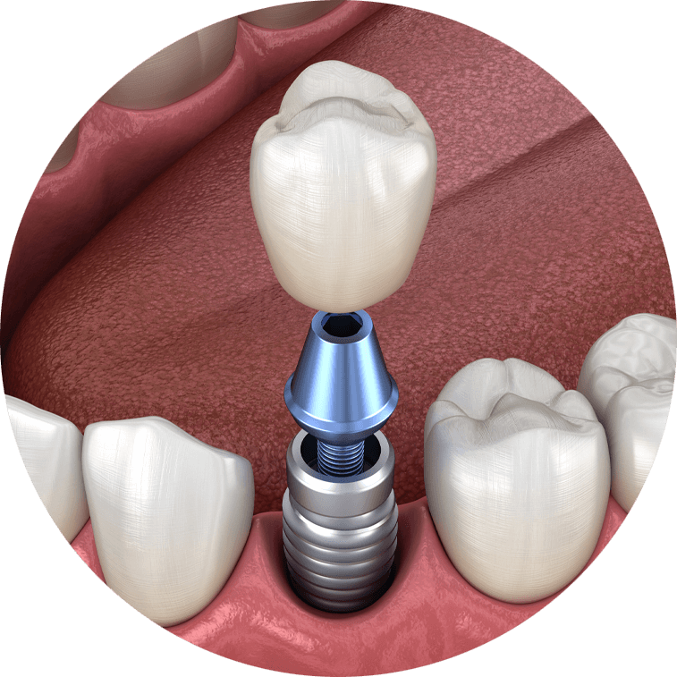 dental implant model