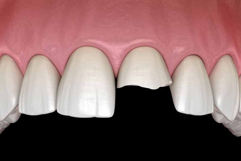 3d render of broken tooth