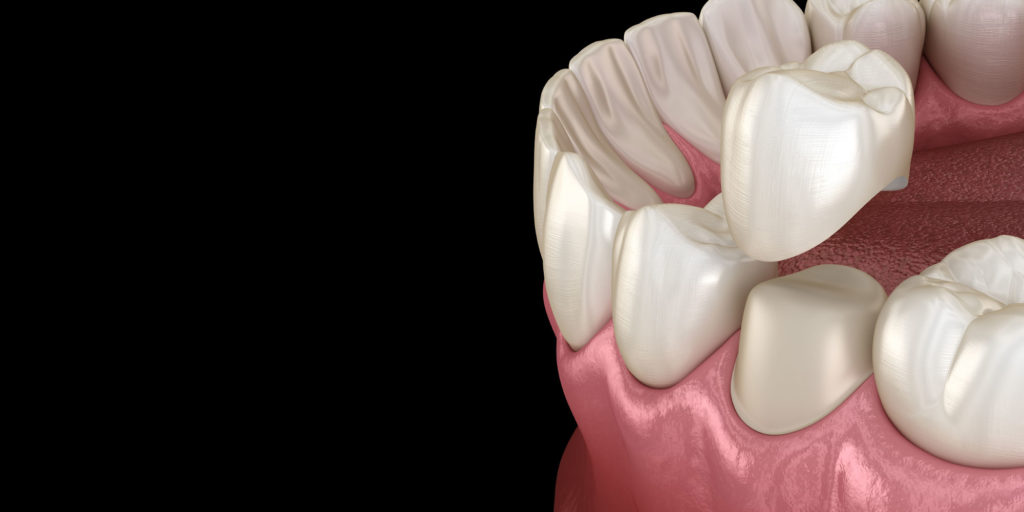 cerec crowns 3d render