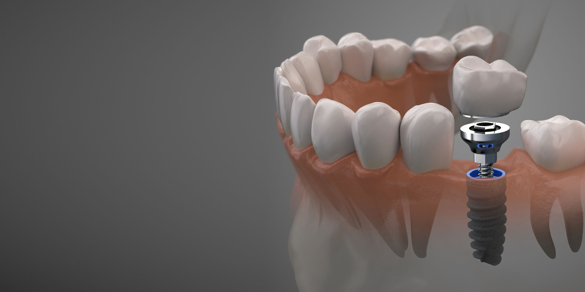 3d render of dental implant
