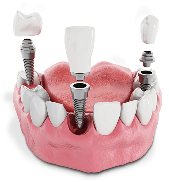 dental implants model