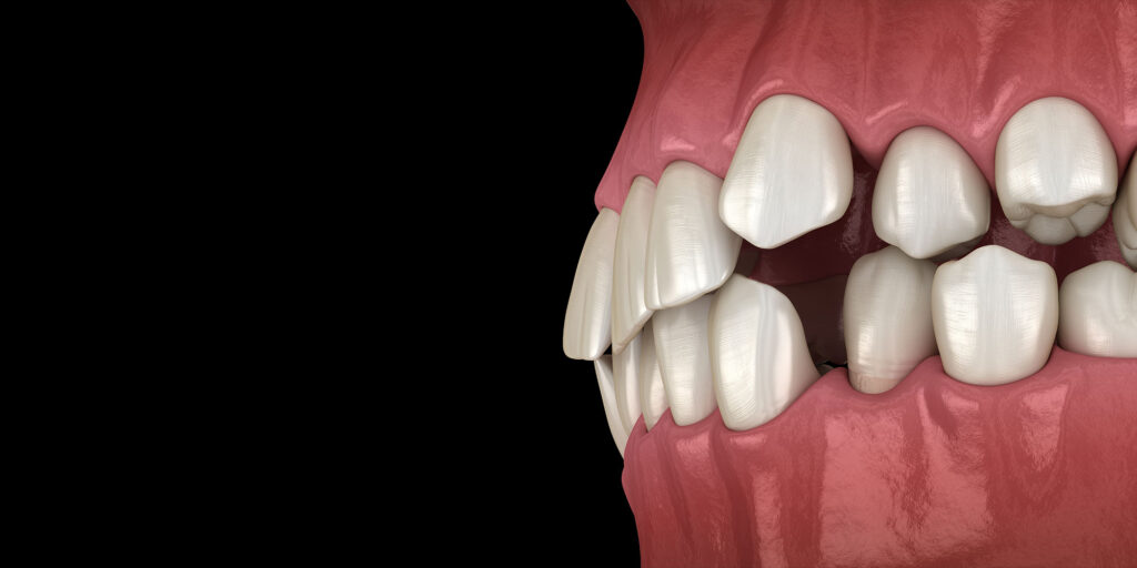 3d render of crooked teeth