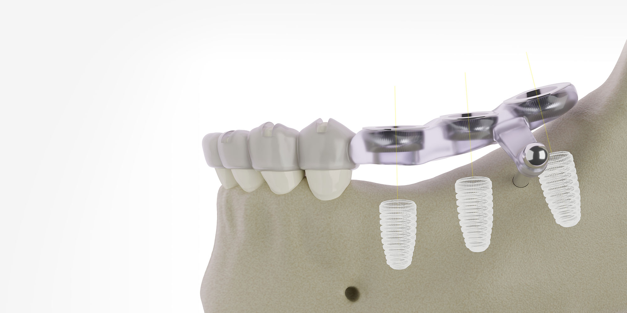 guided dental implant surgery